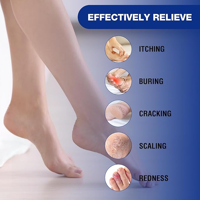CHUNY Foot Cream for Cracked Heels Cream - Extra Strength for Cracked Heels, Dry Skin & Itchy Feet – Soothes Burning, Scaling & Irritation for Men and Women