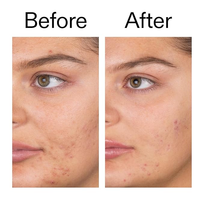 The INKEY List Salicylic Acid Cleanser, Face Wash for Blemishes, Blackheads, Oily Skin and Breakouts, Non-Drying Facial Cleanser Safe for All Skin Types, 5.0 fl oz