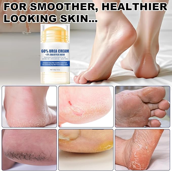60% Urea Foot Cream Care Stick for Feet Plus 2% Salicylic Acid, 2026 New Urea Heel Stick Cream 60 Percent Foot Callus Remover Cream for Feet Maximum Strength, for Dry Cracked Heels, Hands, Knees (2)