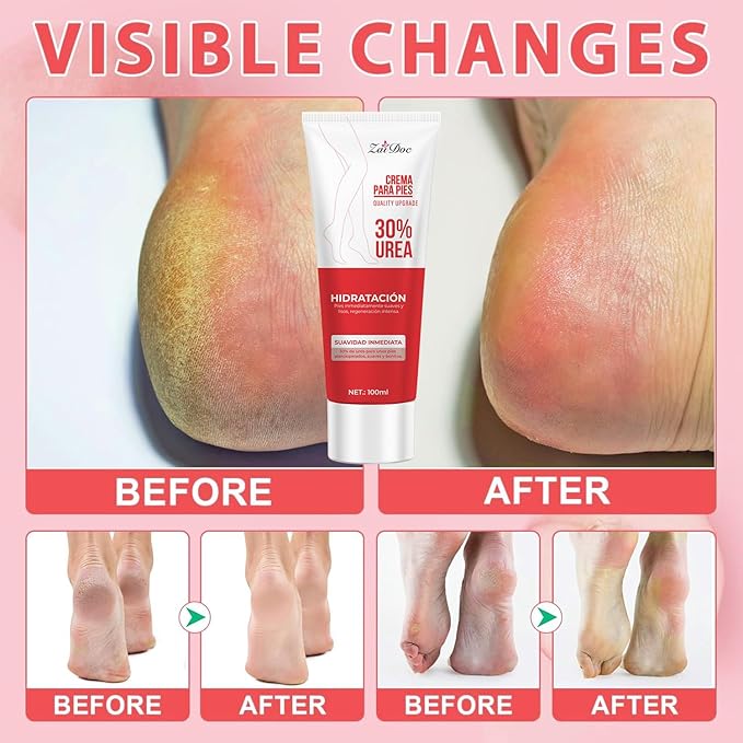 Urea Cream 30 Percent for Feet 3.38 oz, Foot Cream and Hand Cream Maximum Strength with Hyaluronic Acid, Aloe Vera for Deep Moisturizes, Callus Remover