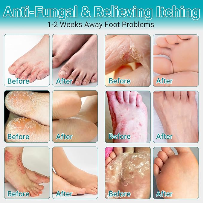 Athletes Foot Treatment Cream, Maximum Strength for Athlete's Foot (Tinea Pedis), Itching, Blister, Burning, Cracking, Scaling, Beriberi,Natural Herbs Antifungal Foot Cream
