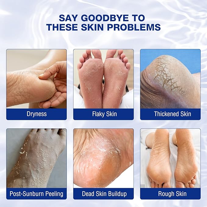 CHUNY Foot Cream for Cracked Heels Cream - Extra Strength for Cracked Heels, Dry Skin & Itchy Feet – Soothes Burning, Scaling & Irritation for Men and Women
