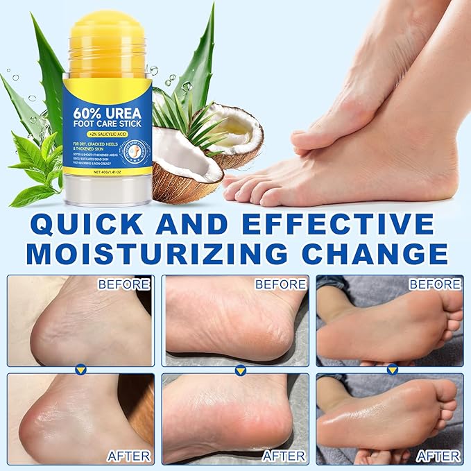 60% Urea Foot Care Stick with 2% Salicylic Acid, Foot Cream Moisturizer for Dry Cracked Feet, Knees, Elbows, Hands,Exfoliating Moisturizer, Dead Skin Remover Foot Balm 1.4oz